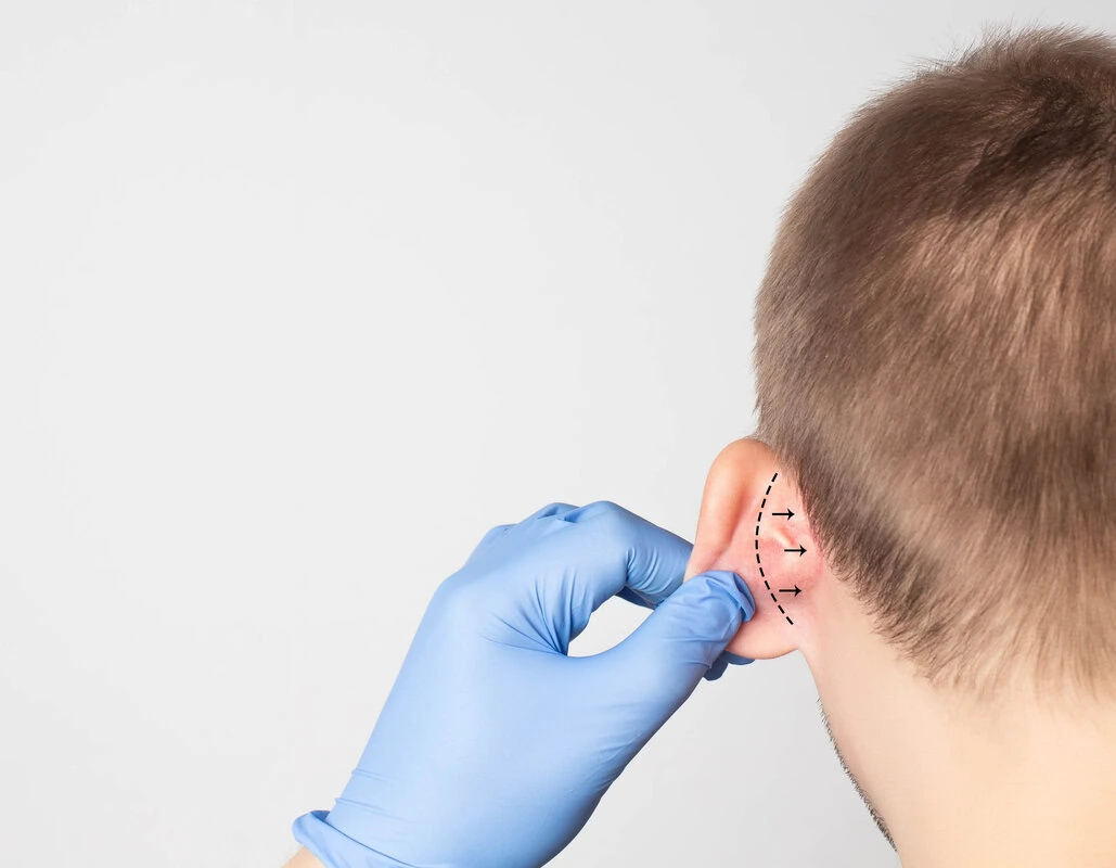 Otoplasty by Norman J Pastorek, MD in New York